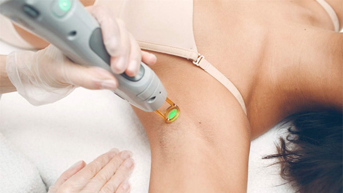 Лазерное удаление волос: что нужно знать об этой процедуре