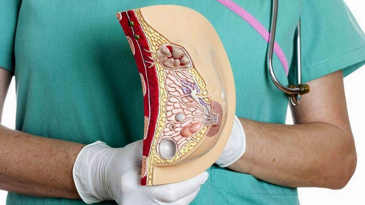 Мастопатия и риск развития рака груди