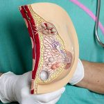 Мастопатия и риск развития рака груди