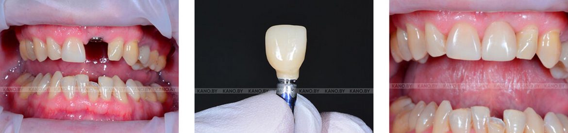 Методы имплантации зубов и их особенности